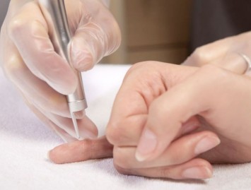 Kaip ir kur gydyti karpas: namuose ar gydytojo kabinete?