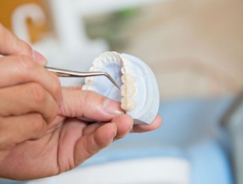 Kaip išvengti periodontito ir turėti sveikus dantis?