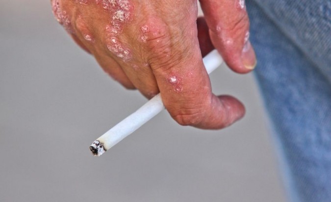 Žvynelinė. Odos ligos simptomai ir gydymas