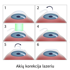 Akių korekcija lazeriu atliekama ir Lietuvoje