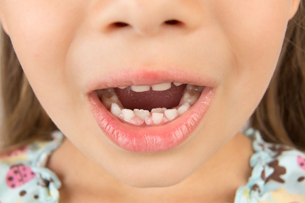 Kreivi vaiko dantukai gali būti tiesinami plokštelėmis