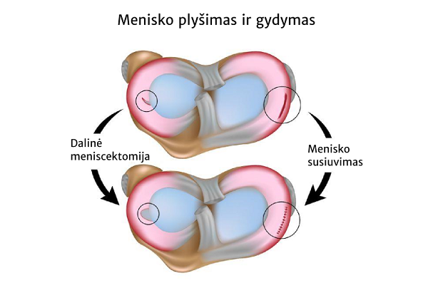 Menisko plyšimas ir gydymas