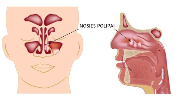 Nosies polipai gali būti gydomi vaistais arba operuojami