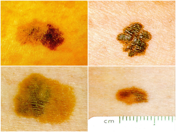 Odos vėžys. Simptomų nuotraukos, savitikra ir onkologės komentarai