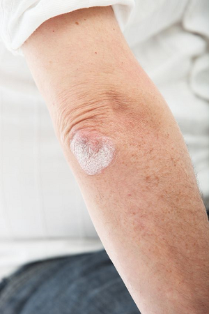 Pleiskanos gali rastis dėl odos ligos