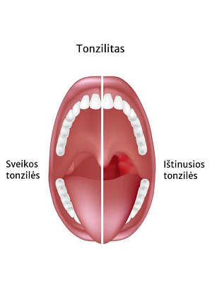 Tonzilitas dažniausiai gydomas medikamentais